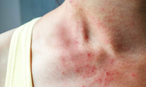 直肠肿瘤术后能活多久-【直肠肿瘤动手术没有生命危险吧】直肠肿瘤术后不良症状有哪些表现 - 直肠肿瘤术后不良症状有哪些网